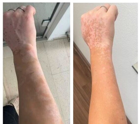 Vitiligo na ruce před léčbou a po léčbě UVB světlem
