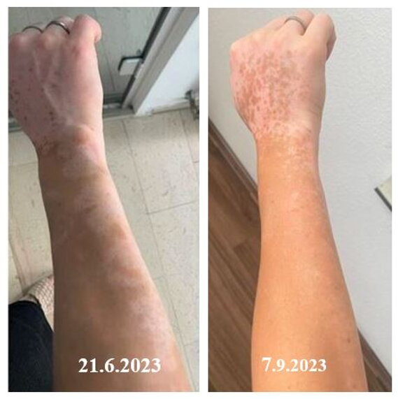 vitiligo repigmentace 