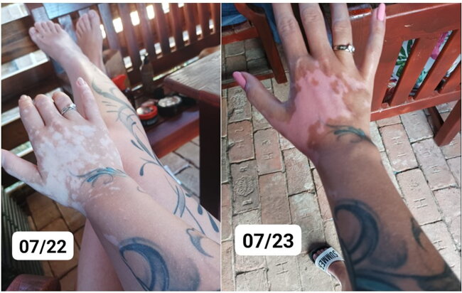 Vitiligo repigmentacia