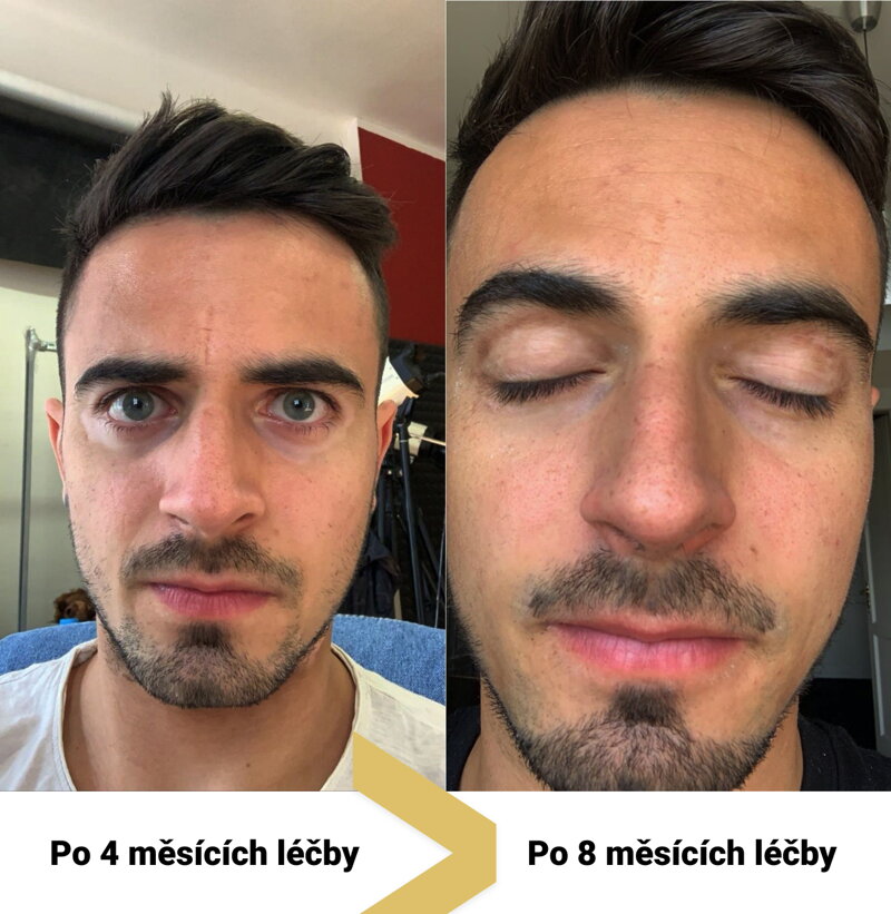 Vitiligo repigmentaci