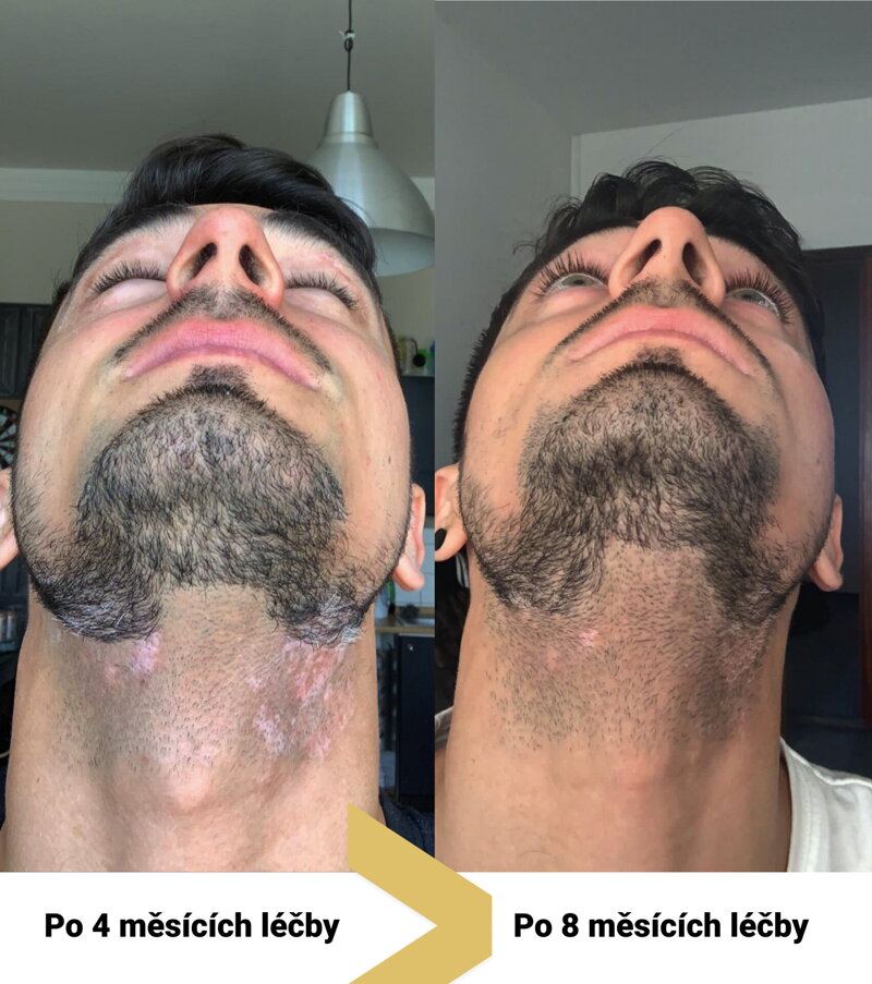 vitiligo léčba