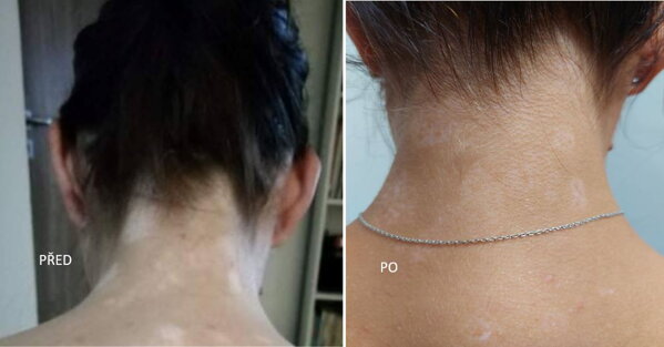 Vitiligo na zátylku