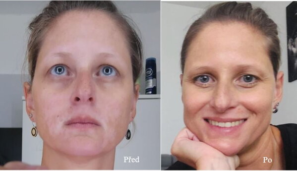 Vitiligo na obličeji před a po léčbě