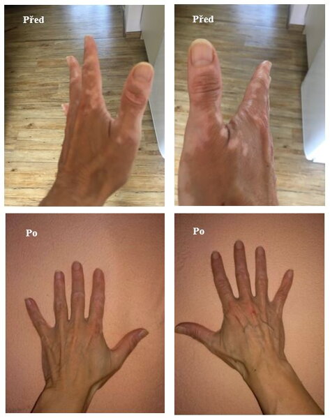 Vitiligo na rukou před a po léčbě