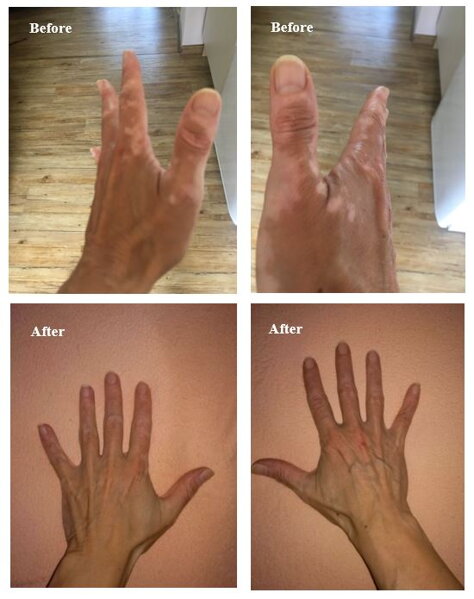 Aktivní, nebo stabilní vitiligo? Jak poznat, že se šíří, a co to mění v léčbě