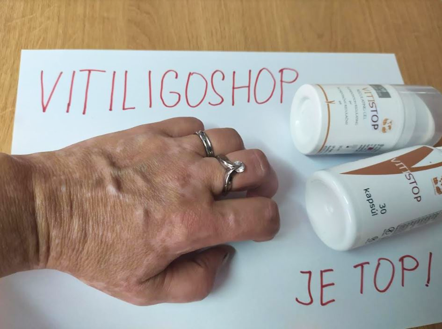 Vitiligo na ruce – Jana V., zákaznice VitiligoShopu