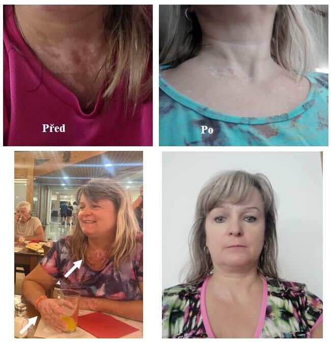 Vitiligo na krku a v dekoltu – Jana V., zákaznice VitiligoShopu