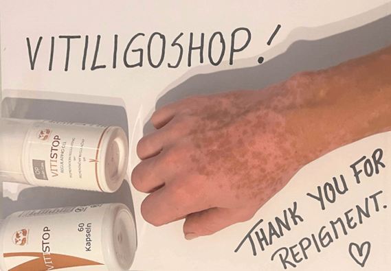 Vitiligo na ruce a prstech – Julie, zákaznice VitiligoShopu