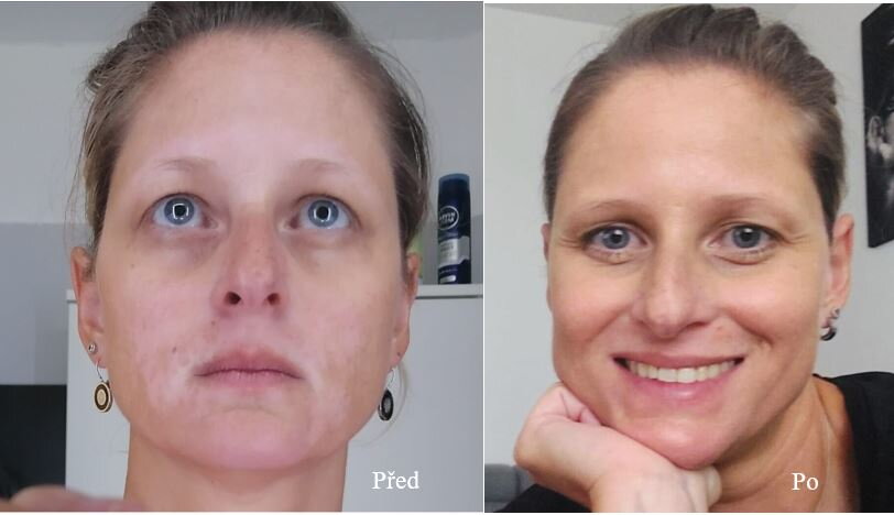 Vitiligo na obličeji před a po léčbě – Petra B., zákaznice VitiligoShopu