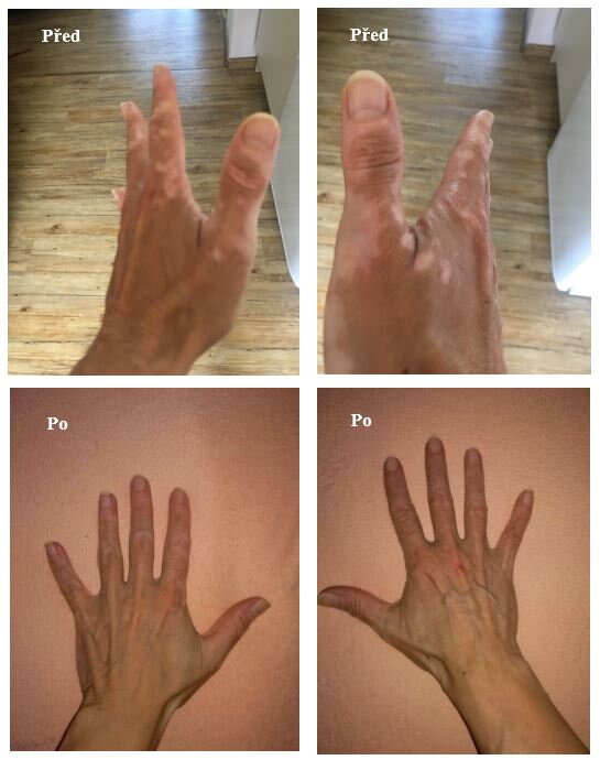 Vitiligo na prstech před a po léčbě – Petra K., zákaznice VitiligoShopu