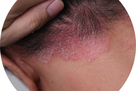 Rady pre ľudí liečiacich sa na psoriázu